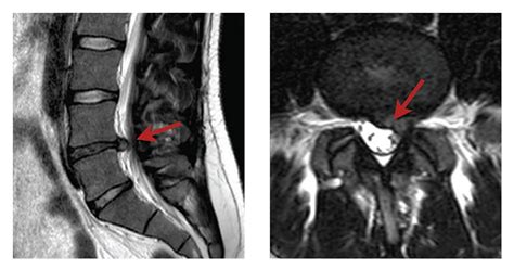 Understanding Lumbar Stenosis and Lumbar Laminectomy - SpinePlus