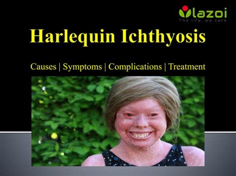 Harlequin Ichthyosis: Causes, symptoms, complications and treatment. | PPT