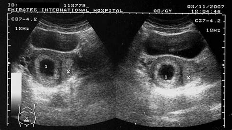 ON - RADIOLOGY: Ultrasound images of Bicornuate uterus with gestation sac