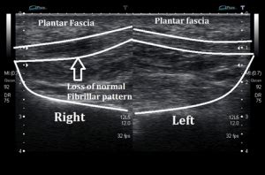 Midportion Plantarfascia Tear - Ankle, Foot and Orthotic Centre