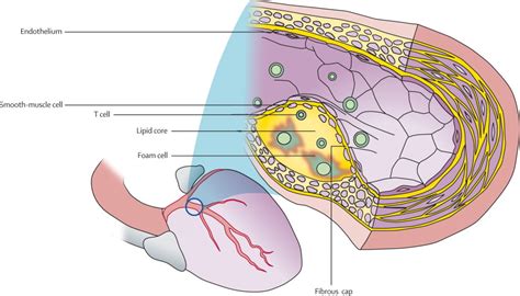 Role of acute infection in triggering acute coronary syndromes - The Lancet Infectious Diseases