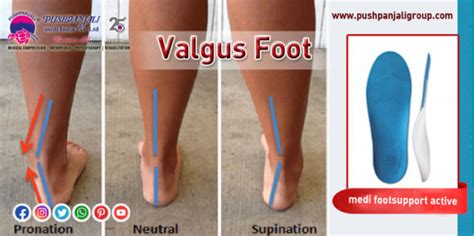 Valgus Foot