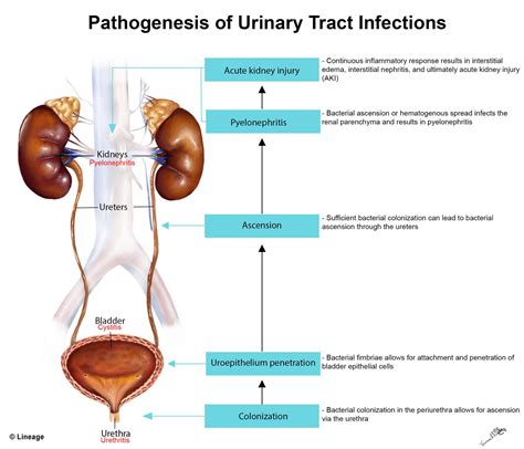 Urinary Tract Infections - Renal - Medbullets Step 2/3