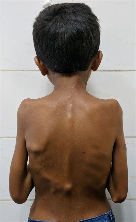 Cureus | Atypical Presentation of Fibrodysplasia Ossificans Progressiva: A Case Report and ...