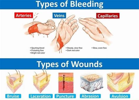 Types of Bleeding - MEDizzy