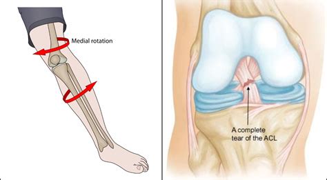 Anterior Cruciate Ligament Rupture | East Africa Orthopaedics