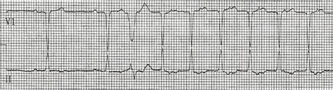 Atrioventricular Nodal Reentrant Tachycardia (AVNRT) ECG Review - Criteria and Examples ...