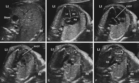 Sonographic Evaluation of the Fetal Heart | Radiology Key