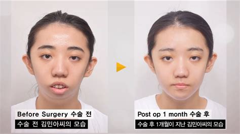 Micrognathia (Small Jaw) improve with double Jaw surgery (Before and ...