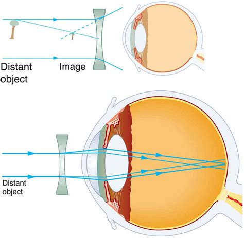 26.2 Vision Correction – College Physics: OpenStax