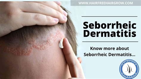 Seborrheic Dermatitis Diet: A Simple Guide - HairFree & HairGrow