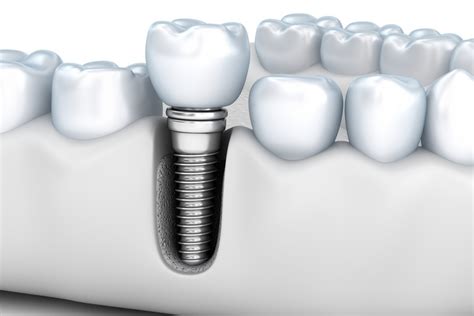 Titanium Power: 3 Benefits of Titanium Dental Implants - The Momma Bird