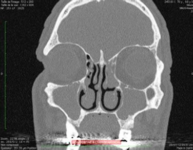 Maxillary And Ethmoid Sinuses