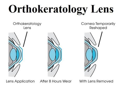 What is Orthokeratology?