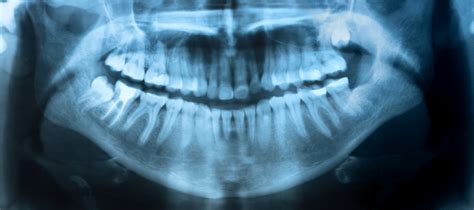 La radiographie dentaire - Dentistes Paris 5 - CSD Paris Austerlitz