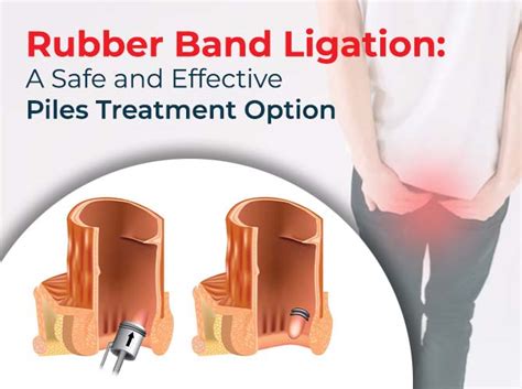 Rubber Band Ligation: An Effective Piles Treatment Option