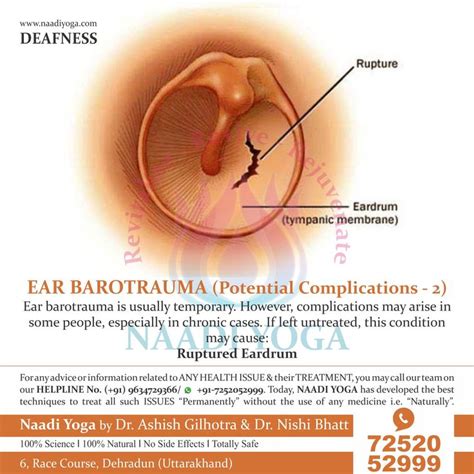 EAR BAROTRAUMA - POTENTIAL COMPLICATIONS - 2 (RUPTURED EARDRUM) | Yoga, Health issues, Health