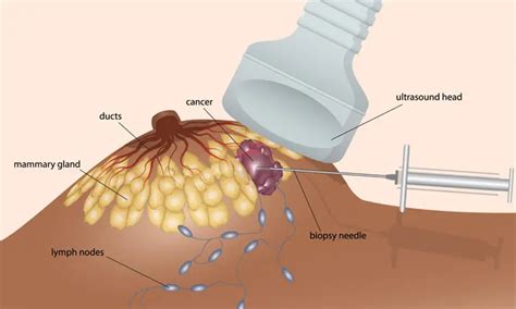 What to Expect During and After a Breast Biopsy