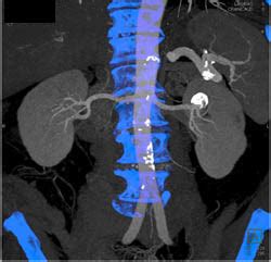 Renal Artery Aneurysm - Kidney Case Studies - CTisus CT Scanning