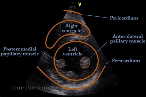 parasternal short axis mid papillary | Diagnostic medical sonography ...