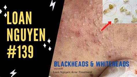 Blackhead Removal Videos November 2020 - HOWOTREMVO