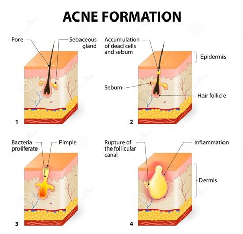 Options to Treat Acne Without Antibiotics - Dy Dermatology Center