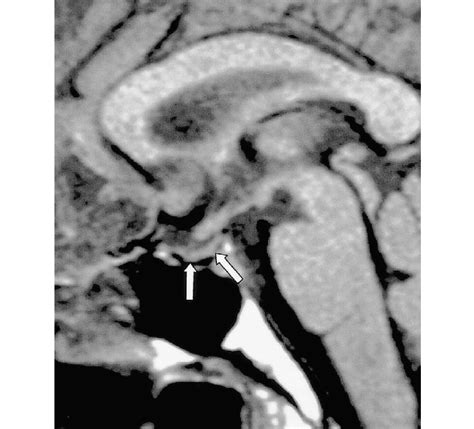 Transection of the pituitary stalk caused by a fall in a 17year-old ...