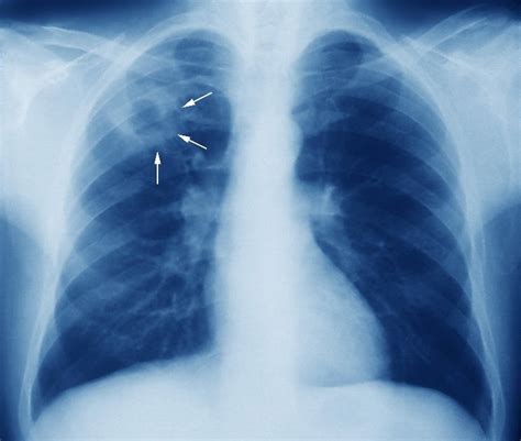 Biomedical sciences and pharmacology: Tuberculosis - A disease old as ...