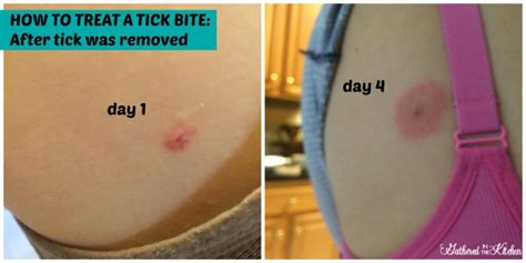 What To Do If You Get A Tick Bite | Gathered in the Kitchen