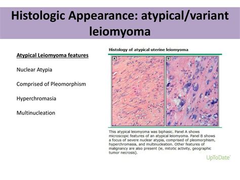 PPT - Uterine Leiomyoma PowerPoint Presentation, free download - ID:2372404