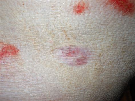 Image Gallery: Secondary Skin Lesions | Clinician's Brief