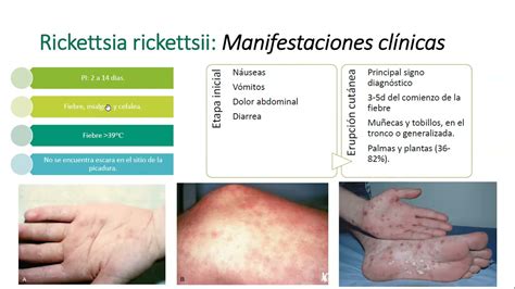 Rickettsiosis - YouTube