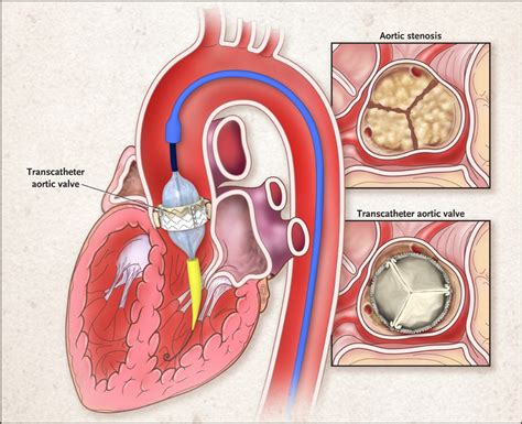 Aortic Valve