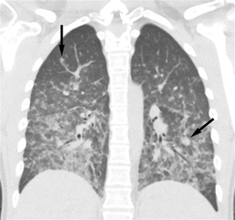 Patchy Ground Glass Opacities In Both Lungs Radiology - Glass Designs