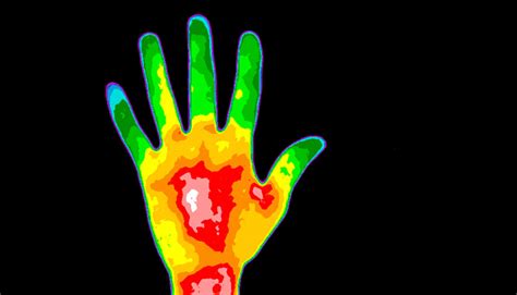 Thermal imaging offers better way to assess burns - Futurity