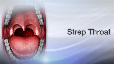 Can Strep Throat Cause Swollen Lips | Lipstutorial.org