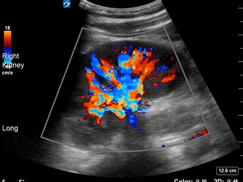 Trauma: Right kidney laceration - Critical Care Sonography