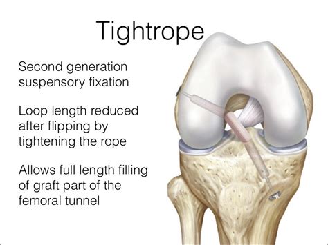 Acl graft fixation options