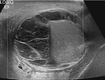 Scrotal Mass and Scrotal Pain | Radiology Key