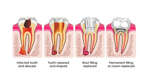 Stages of Root Canal Treatment | ArticleCube