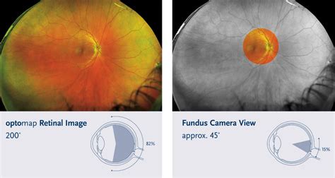 OPTOMAP Retinal Scan - Waltham Abbey Opticians