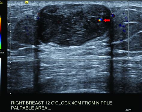 Epidermoid Cyst in Male Patient Mimicking a Suspicious Breast Mass and Consequences of Biopsy ...