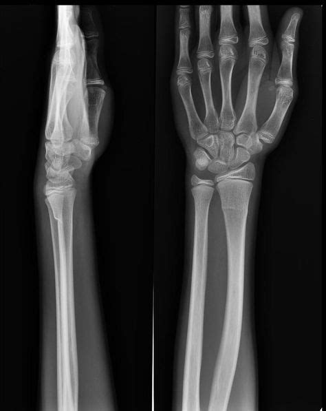 Incomplete fracture | Radiology Case | Radiopaedia.org | Radiology ...