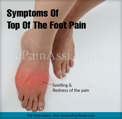 Top of the Foot Pain: Treatment, Exercises, Causes, Symptoms