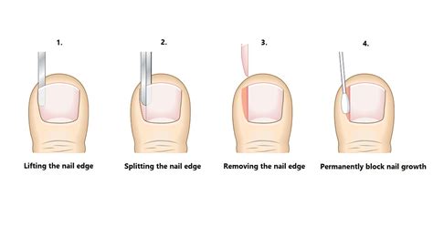 Partial Nail Avulsion (Ingrown Toenail Surgery) | Straits Podiatry