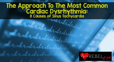 The Approach To The Most Common Cardiac Dysrhythmia: 8 Causes of Sinus ...