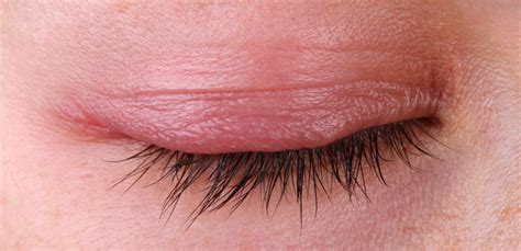 What You Need To Know About Blepharitis — HealthDigezt.com