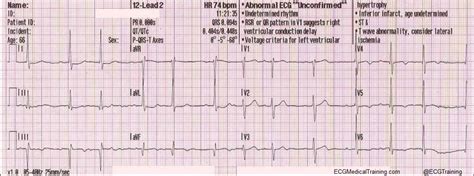 Importance of Lead aVL in STEMI Recognition - ECG Medical Training