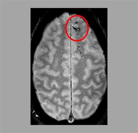 Microbleeds – Too Small to Be Detected on CT Scans – May Worsen Outcome After Head Injury