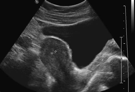 Normal Uterus Measurements Ultrasound